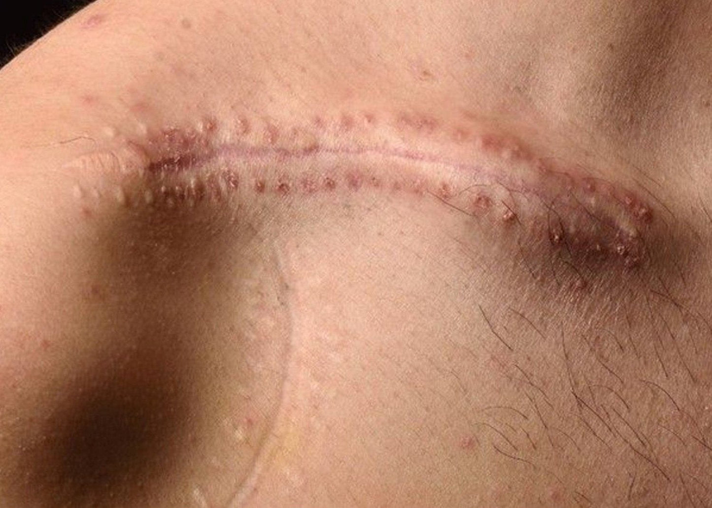 Scarring Masterclass - All Modules