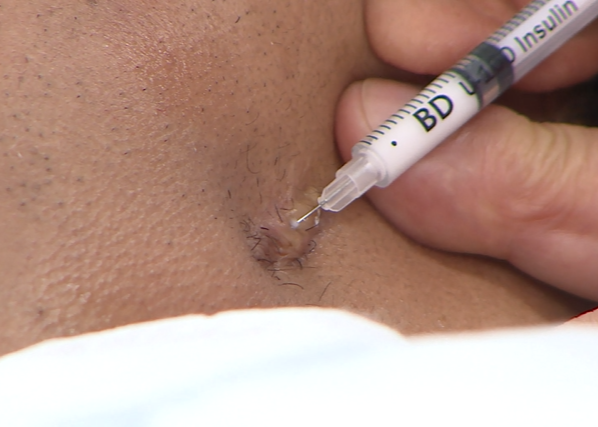 Practical 4 Treatment of Keloid Scar with Intralesional Injection