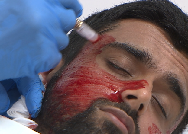 Practical 2,2A,2B,2C and 2D Auto Dermal Needling/ Platelet Rich Plasma Delivery combined with automated Dermal Needling